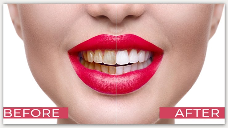 Teeth Whiten in Photoshop